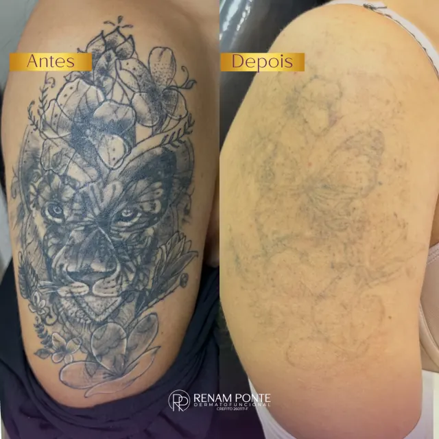 Antes e depois de remoção de tatuagem no braço — tatuagem grande de leão bastante clareada
