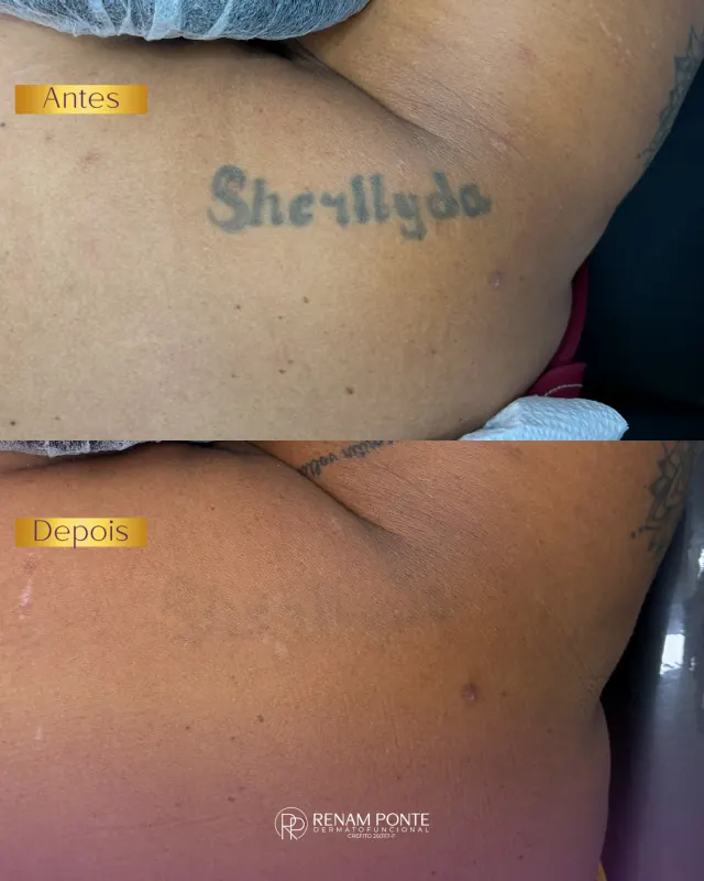 Antes e depois de remoção de tatuagem de nome nas costas — tatuagem praticamente removida