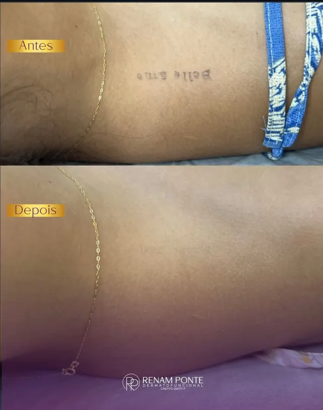 Antes e depois de remoção de tatuagem fina escrita na lateral do corpo — tatuagem removida
