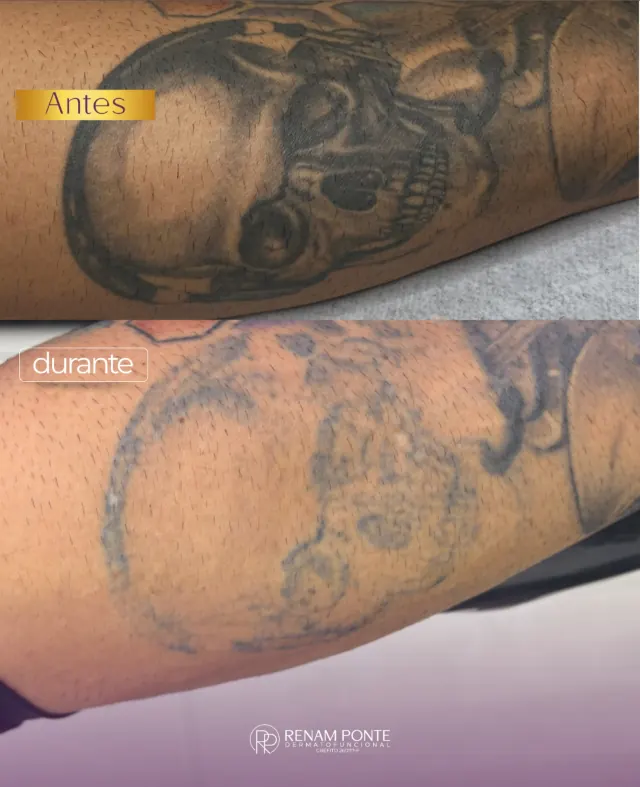 Antes e durante a remoção de tatuagem de caveira na perna — clareamento progressivo