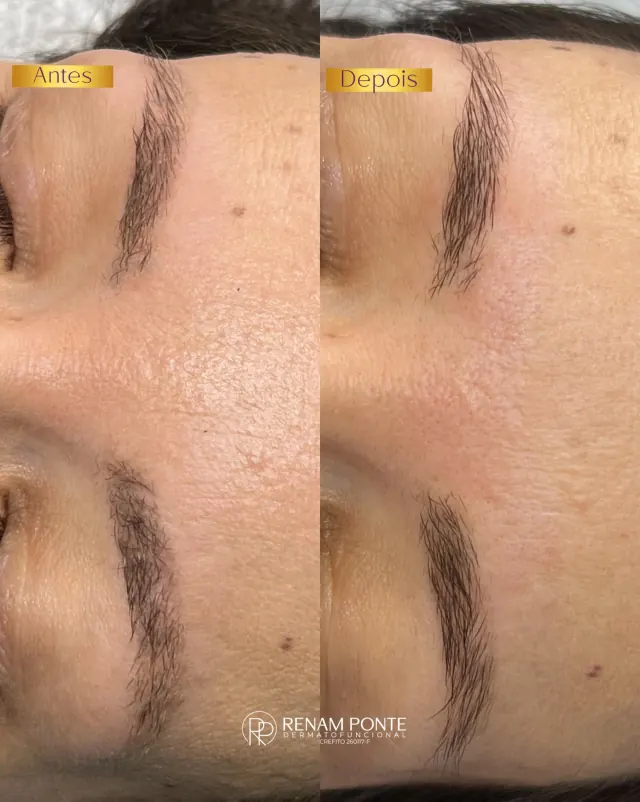 Antes e depois de remoção de micropigmentação de sobrancelhas